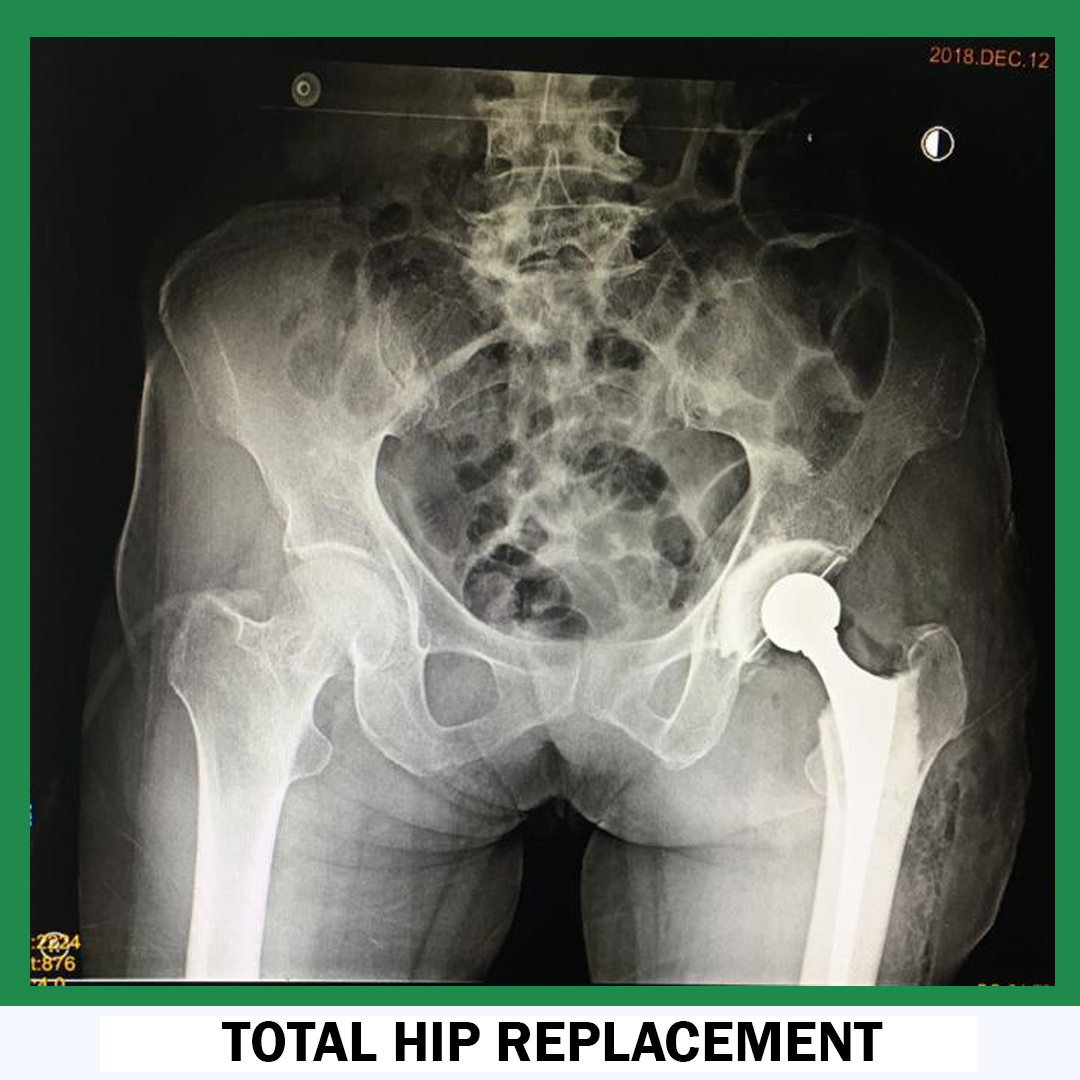Total Hip Replacement