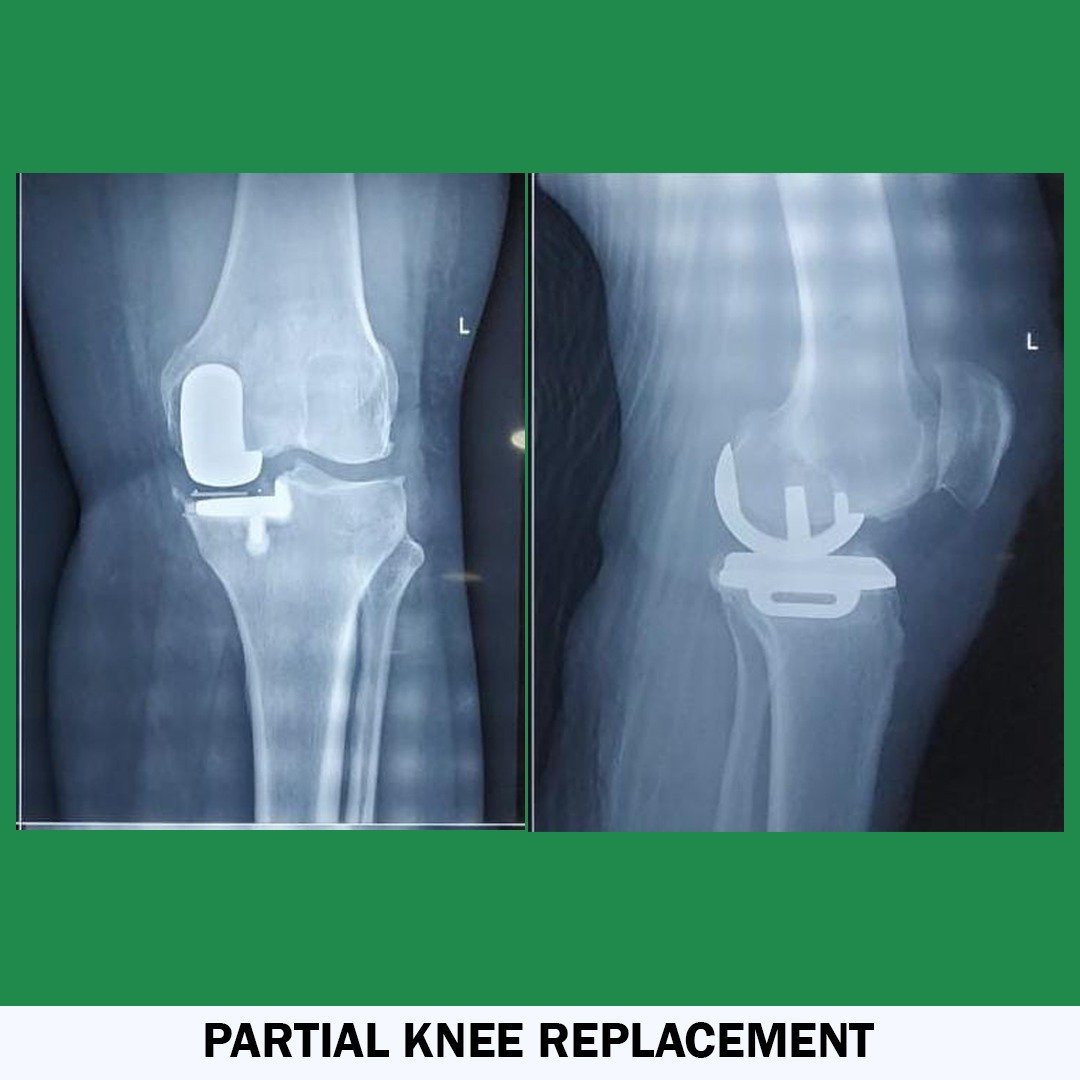 Partial Knee Replacement