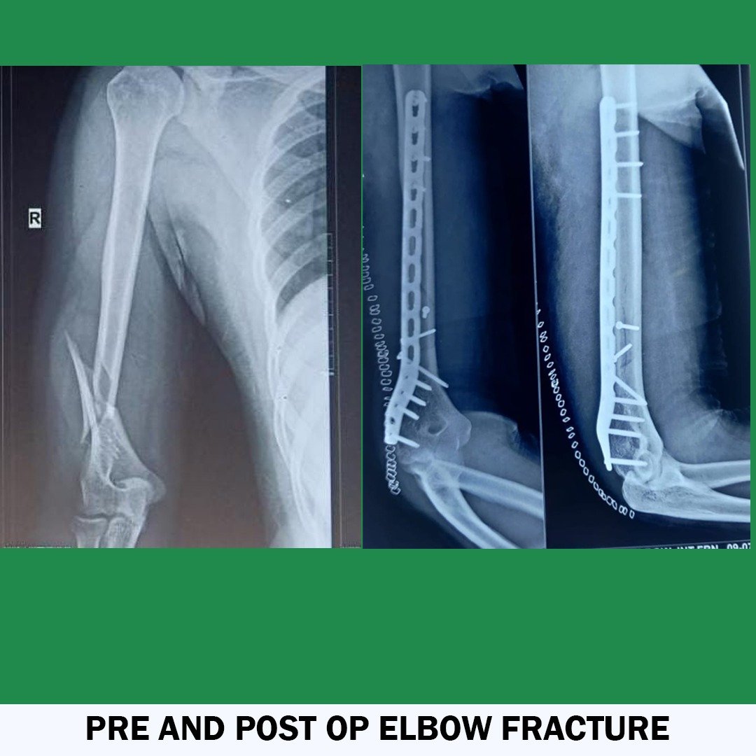Pre And Post OP Elbow Fracture